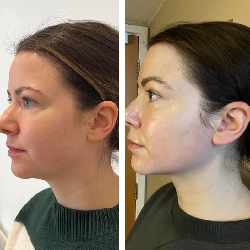 Before/after Victoria S. — de-puffed face with Lyphéa
